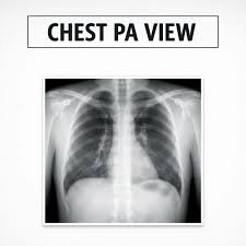 Chest X-Ray (PA View) (ఛెస్ట్ ఎక్స్-రే (PA View)