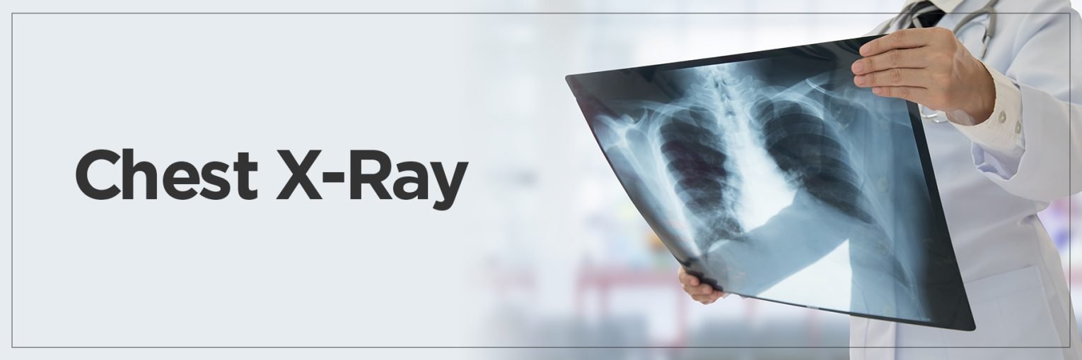 Chest X-Ray (PA View) (ఛెస్ట్ ఎక్స్-రే (PA View)